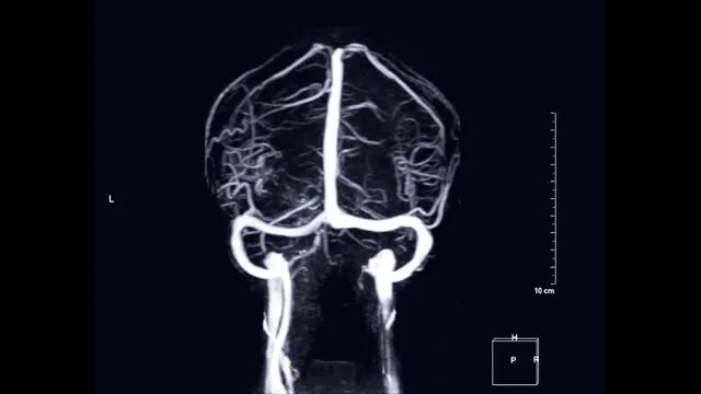 Венография головного мозга. МР-венография головного мозга. Венография головного мозга показания. МР венография головы.
