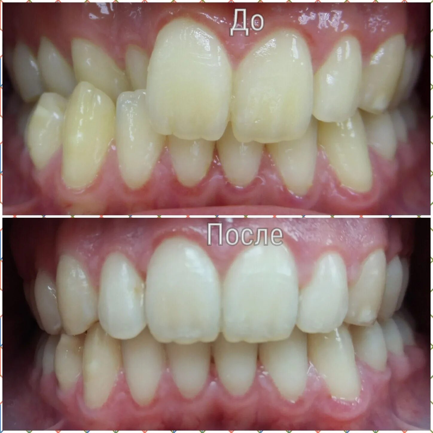 хабенский виниры. элайнеры eurokappa. исправление зубов винирами. исправление кривых зубов винирами. брекеты до и после зубы прикус.