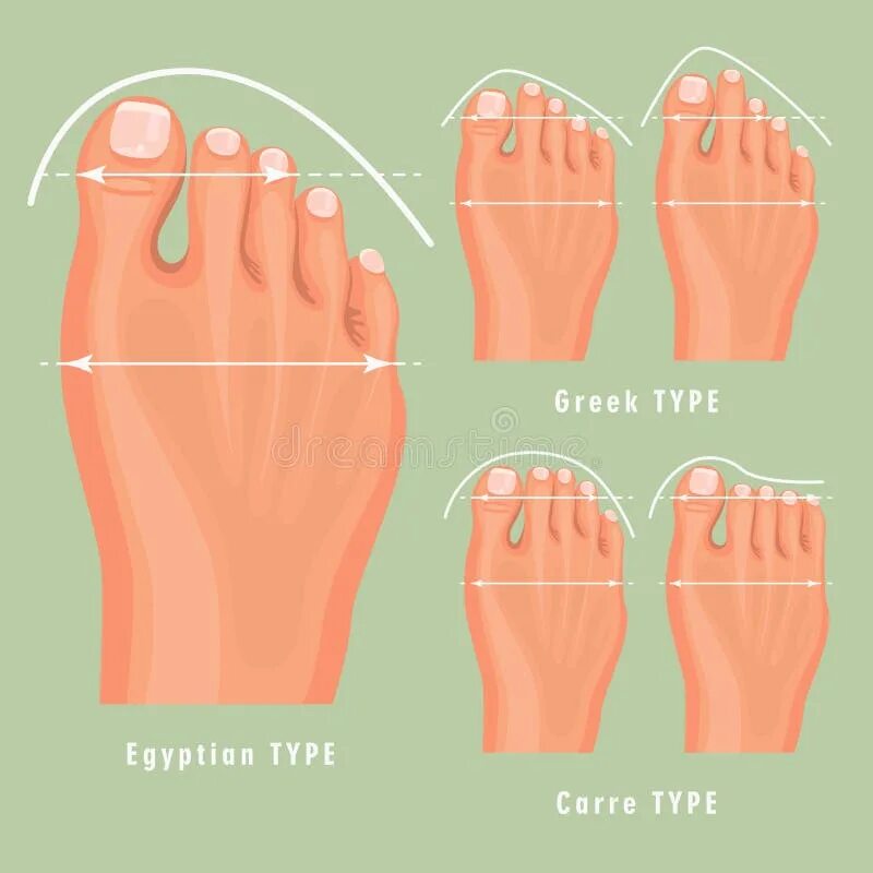 Типы стопы. Римская и Греческая стопа. Греческая форма стопы. Пальцы на ногах разновидности. 3 типа стопы