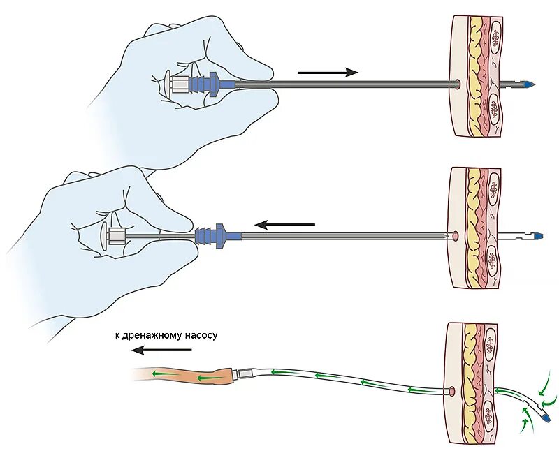 троакар катетер. катетер троакар 32ch. троакар катетер 16. катетер троакар 32ch. катетер дренажный с троакаром.