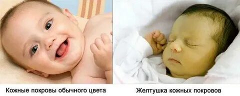 Откуда у новорожденного желтуха