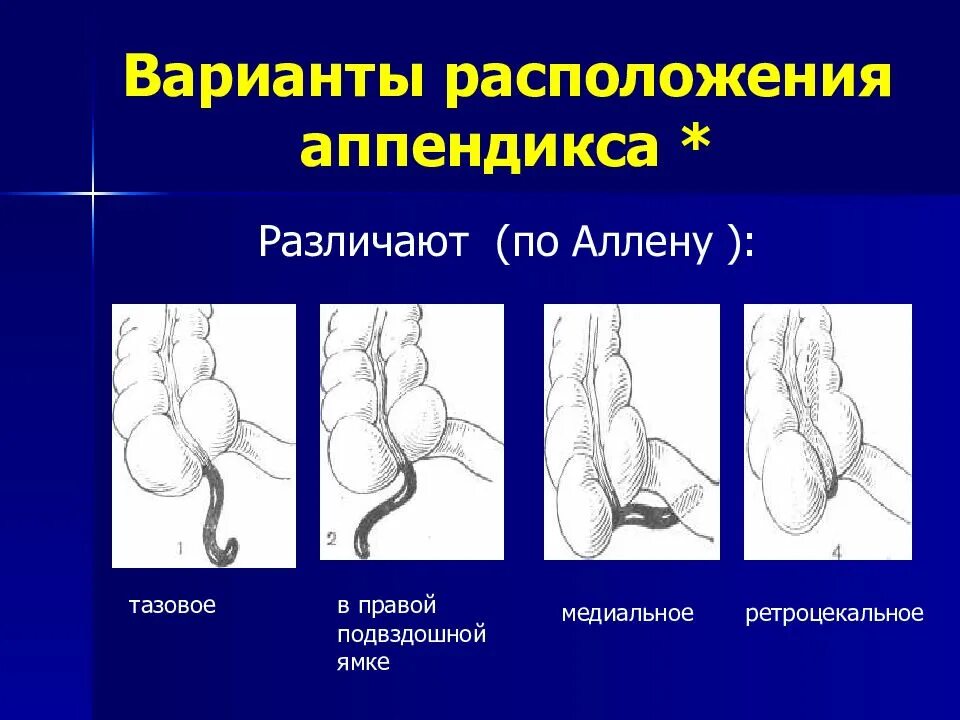 Ретроцекальный аппендицит расположение. Ретроцекальный аппендицит аппендэктомия. Ретроцекальное расположение аппендикса. Ретроцекальный острый аппендицит расположение. Локализация острого аппендицита