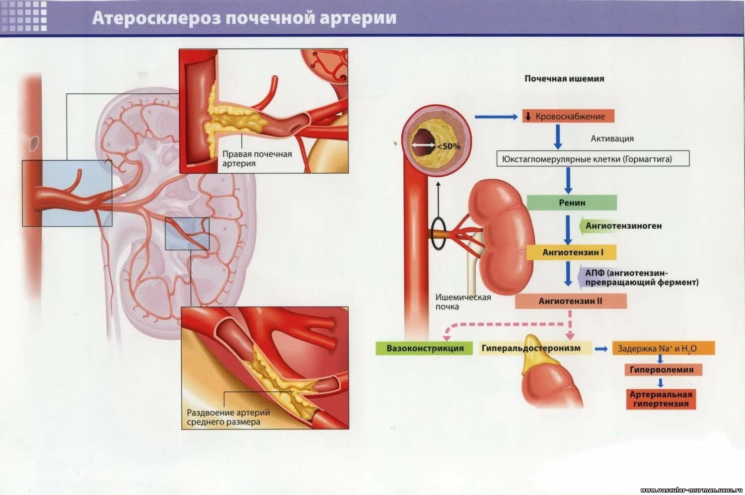 Давление при заболевании почек. Атеросклероз артерий почек почечная форма. Осложнения атеросклероза артерий почек. Атеросклероз почечных сосудов характеризуется:. Гипертоническая болезнь сосуды почек.