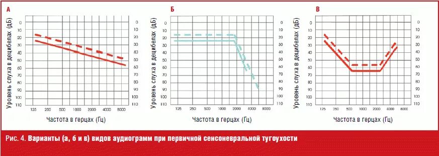 Кондуктивная тугоухость лечение. Аудиометрия при сенсоневральной тугоухости. кондуктивная тугоухость 2 степени аудиограмма. хроническая сенсоневральная тугоухость аудиограмма. аудиограмма при нейросенсорной тугоухости.
