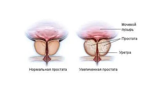 Что такой предстательной железы