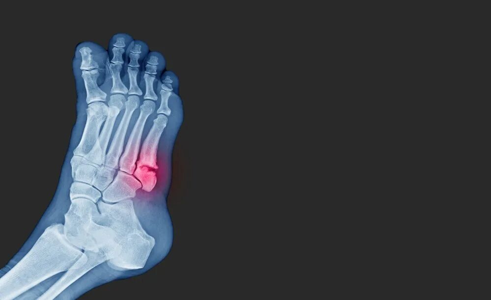 5 foot 10. Перелом плюсневой кости 5 пальца. Рентген 5 плюсневой кости. Перелом плюсневой кости 5 пальца стопы. Пятая плюсневая кость стопы перелом.