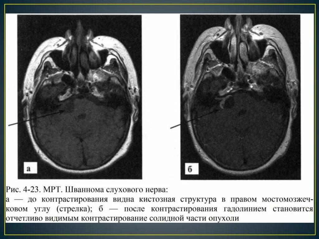 Мрт головного мозга мосто мозжечкового угла. Невринома мосто-мозжечкового угла кт. мосто-мозжечковый угол мрт. невринома мозжечка мрт. мосто-мозжечковый угол на кт.