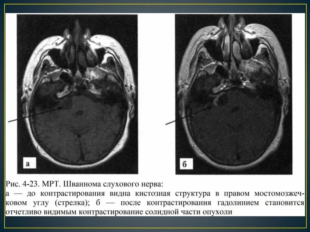 Мрт черепных нервов. Невринома мосто-мозжечкового угла кт. Мосто-мозжечковый угол анатомия мрт. Невринома мозжечка мрт. Мосто-мозжечковый угол на кт.