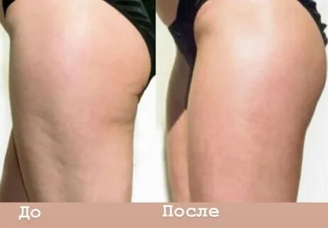 Целлюлит дряблость кожи