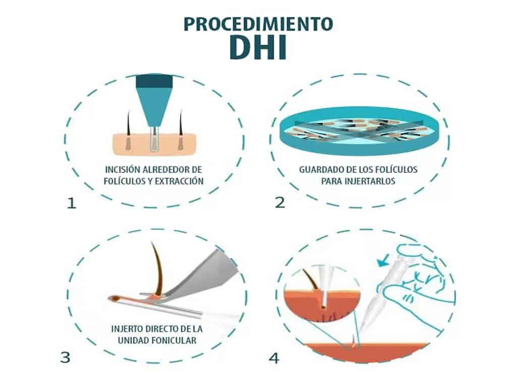 Dhi трансплантация волос. Трансплантация волос dhi методом. Метод пересадки волос dhi. Dhi трансплантация волос. Пересадка волос иконки.