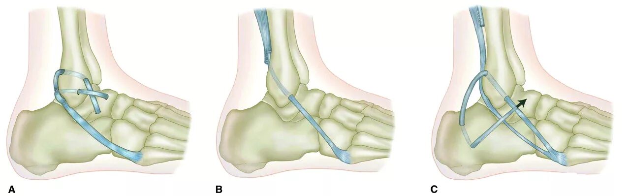 Дисторсия голеностопного сустава. Разрыв связок голеностопного сустава. Таранно-малоберцовая связка голеностопного сустава растяжение. Повреждение связок голеностопного сустава операция. Трещина связке