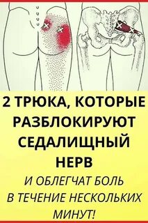 Как вылечить седалищный нерв на правой ягодице