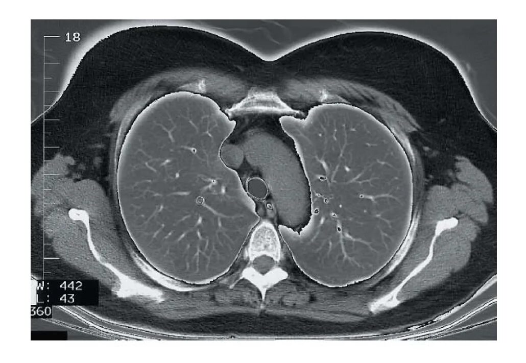 Диагнокад срезы кт. Срезы кт. Компьютерная томография легких. Срезы кт. Кт легких аксиальный срез.