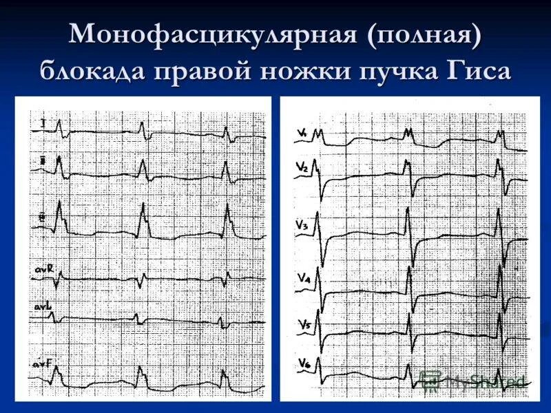 Блокада пнпг на экг. Полная блокада правой ножки п. Экг при блокаде правой и левой ножки пучка гиса. Блокада лнпг на экг. Полная блокада правой ножки п.