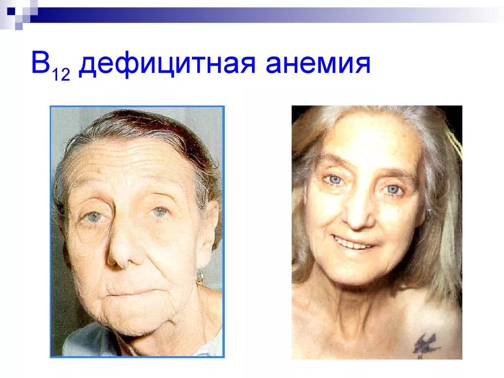 Пациент с железодефицитной анемией
