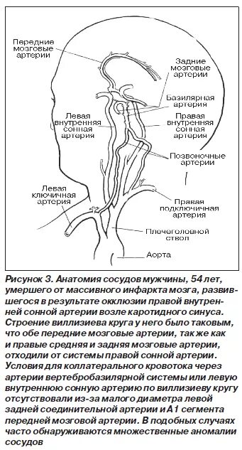 Аневризма сонной артерии что это. Виллизиев круг сегменты артерий. Интракраниальные сегменты внутренних сонных артерий. Внутренняя Сонная артерия сегменты анатомия. Аневризма сонной артерии сегмент с1.