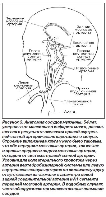 Аневризма сонной артерии что это