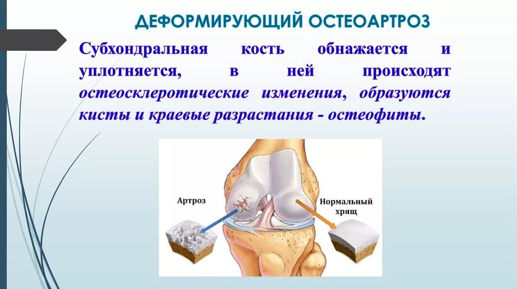 Диагноз доа суставов. Деформирующий остеоартроз. При деформирующем остеоартрозе. Деформирующий остеоартроз (доа). Проблемы пациента при деформирующем остеоартрозе.