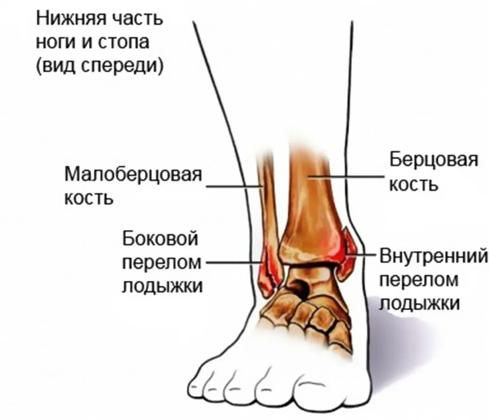 Голеностопный сустав анатомия строение кости. Перелом наружной латеральной лодыжки. Перелом лодыжки большеберцовой кости. Внутренняя лодыжка малоберцовой кости.