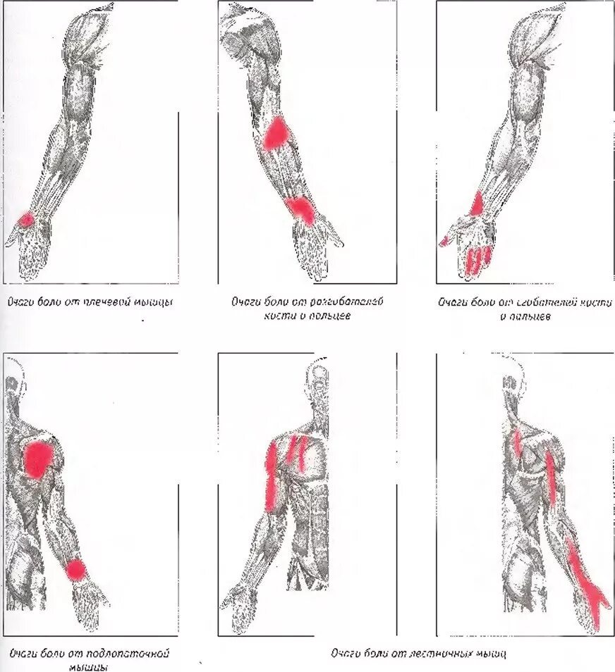 Заболевание мышц рук. Мышцы от кисти до локтя. Болит мышца предплечья левой руки. Ломота в руке от локтя до кисти.