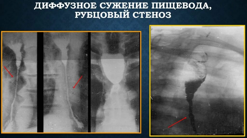 Послеожоговые стриктуры пищевода рентген. Сужения пищевода (oesophagus). Сужение просвета пищевода на рентгене. Бифуркационное сужение пищевода.