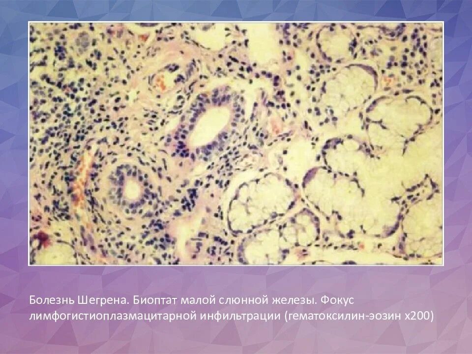 Восралениеслюнных желез. Синдром шегрена слюнные железы. Трубная слюнная железа. Синдром шегрена симптомы диагностика. Болезнь шегрена слюнные железы.
