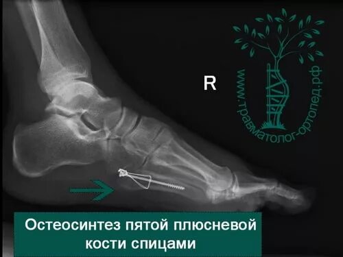 Остеосинтез 5 плюсневой кости. Вывих в суставе лисфранка. Перелом 5 плюсневых костей. Рентген перелома 5 плюсневой кости. Перелом 5 плюсневой кости со смещением остеосинтез.