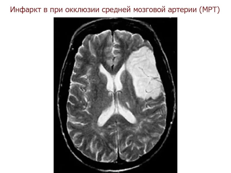 Онмк в бассейне сма. Мрт при инсульте в бассейне средней мозговой артерии. инфаркт головного мозга в бассейне правой средней мозговой артерии. ишемический инфаркт передней мозговой артерии на кт. ишемический онмк на кт.