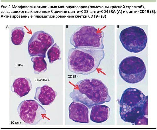 Атипичные мононуклеары в крови. Атипичные мононуклеары и атипичные лимфоциты. Широкоплазменные лимфоциты. Инфекционный мононуклеоз мазок крови. Реактивные лимфоциты у детей