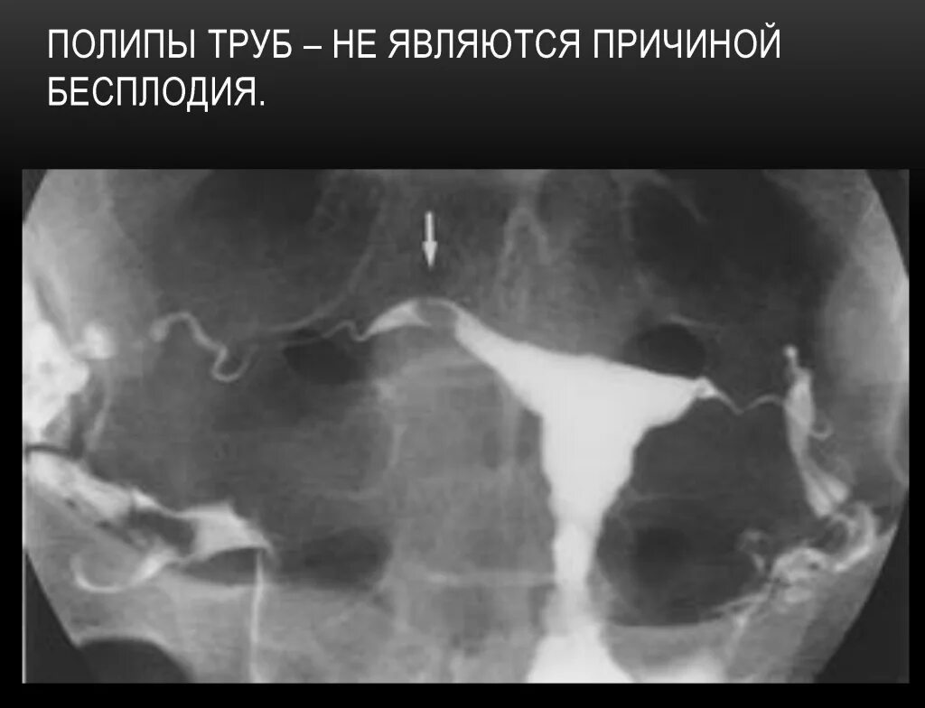 Непроходимость труб фото PELVIC INFLAMMATORY DISEASE ppt video online download