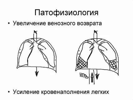 Обструкция легких