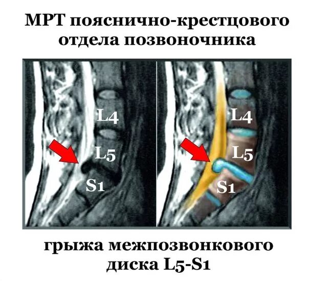 Грыжа l3-l4. Грыжа l5-s1 мрт. Протрузия диска l5-s1.