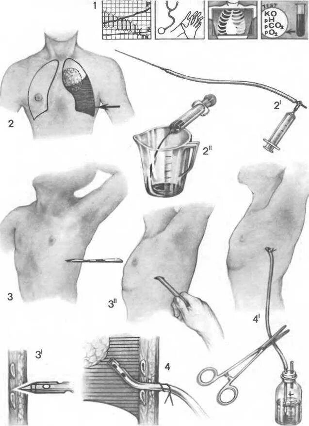 Через сколько снимать дренаж. Дренирование плевральной полости при пневмотораксе инструменты. Дренирование плевральной полости по Бюлау. Дренирование плевральной полости при пневмотораксе техника. Дренирование плевральной полости при пневмотораксе.