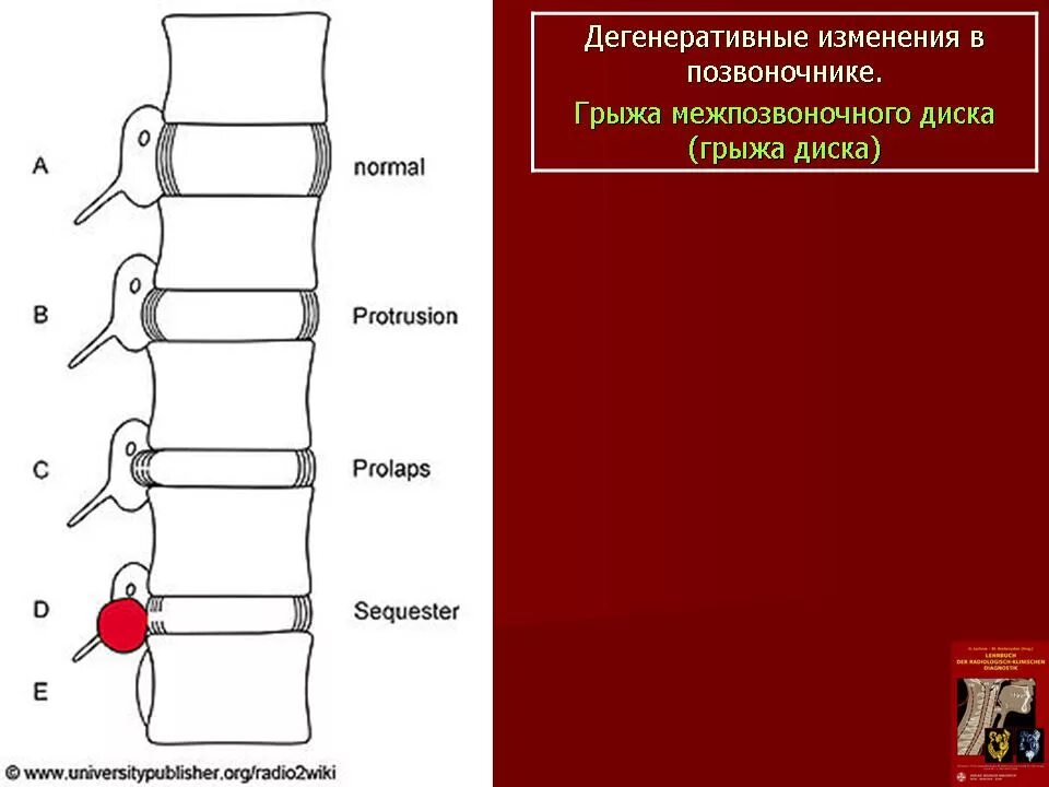 Грыжа позвоночника схема. Диско-радикулярный конфликт позвоночник. Радикулярные карманы позвонков это. Грыжа позвоночника Размеры. Дистрофические изменения позвоночника лечение