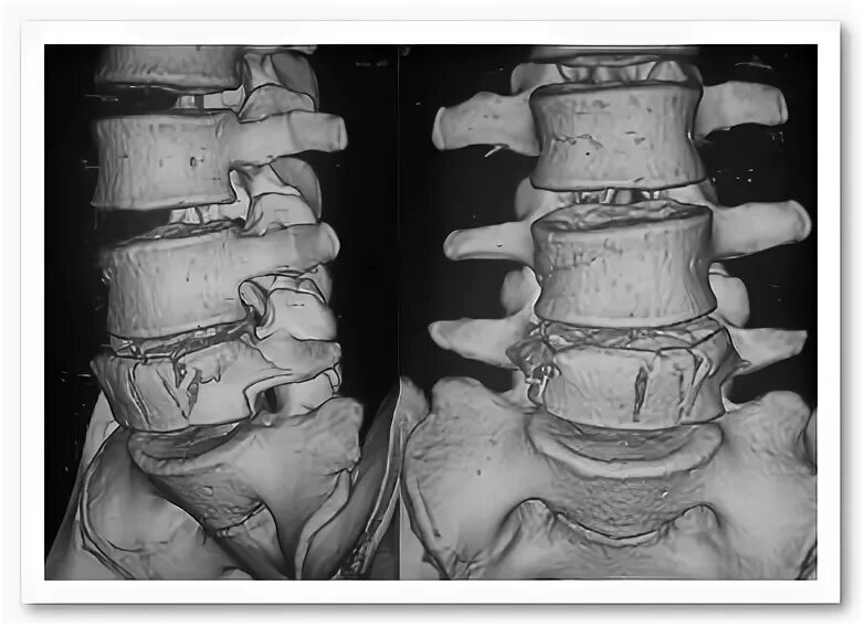 Неосложненный компрессионный перелом. Компрессионный перелом л3 л4. Компрессионный перелом позвоночника th-5-6. Нелеченный компрессионный перелом позвоночника.