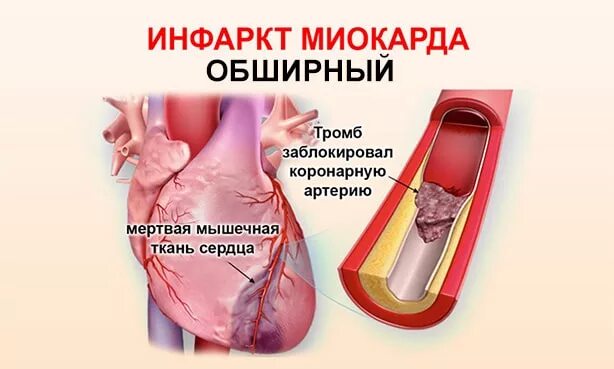 Осложнение на сердце после. Обширный инфаркт миокарда. Обширный инфаркт Микард. Обжирного инфаркт миокарда.