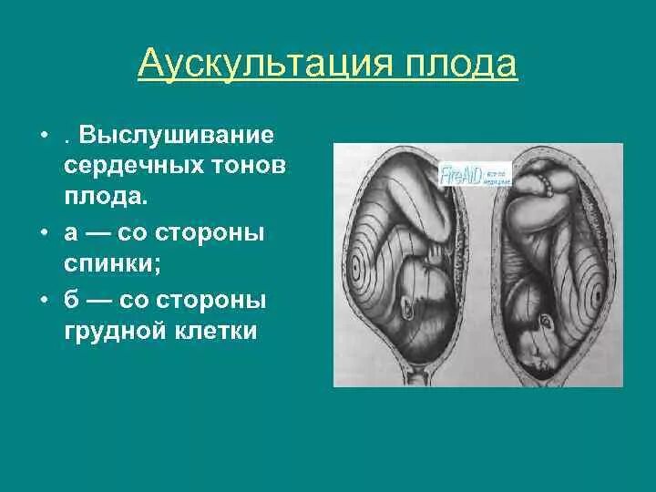 Сердцебиение плода при позиции выслушивается. Методика выслушивания сердцебиения плода. аускультация плода.