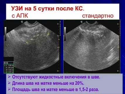 Через сколько можно родить после кесарева