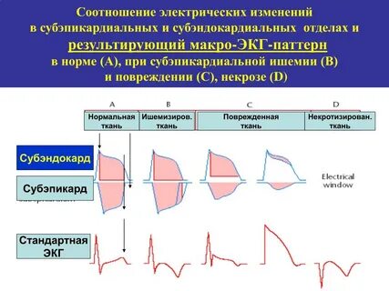 Ишемия миокарда на экг