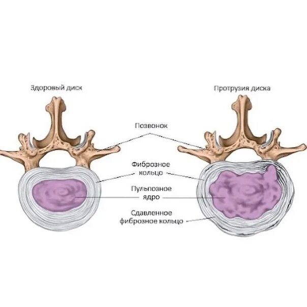 Пульпозное ядро межпозвоночного диска. Пульпозное ядро и фиброзное кольцо. Позвонок пульпозное ядро. Протрузия дисков позвоночника что это такое.