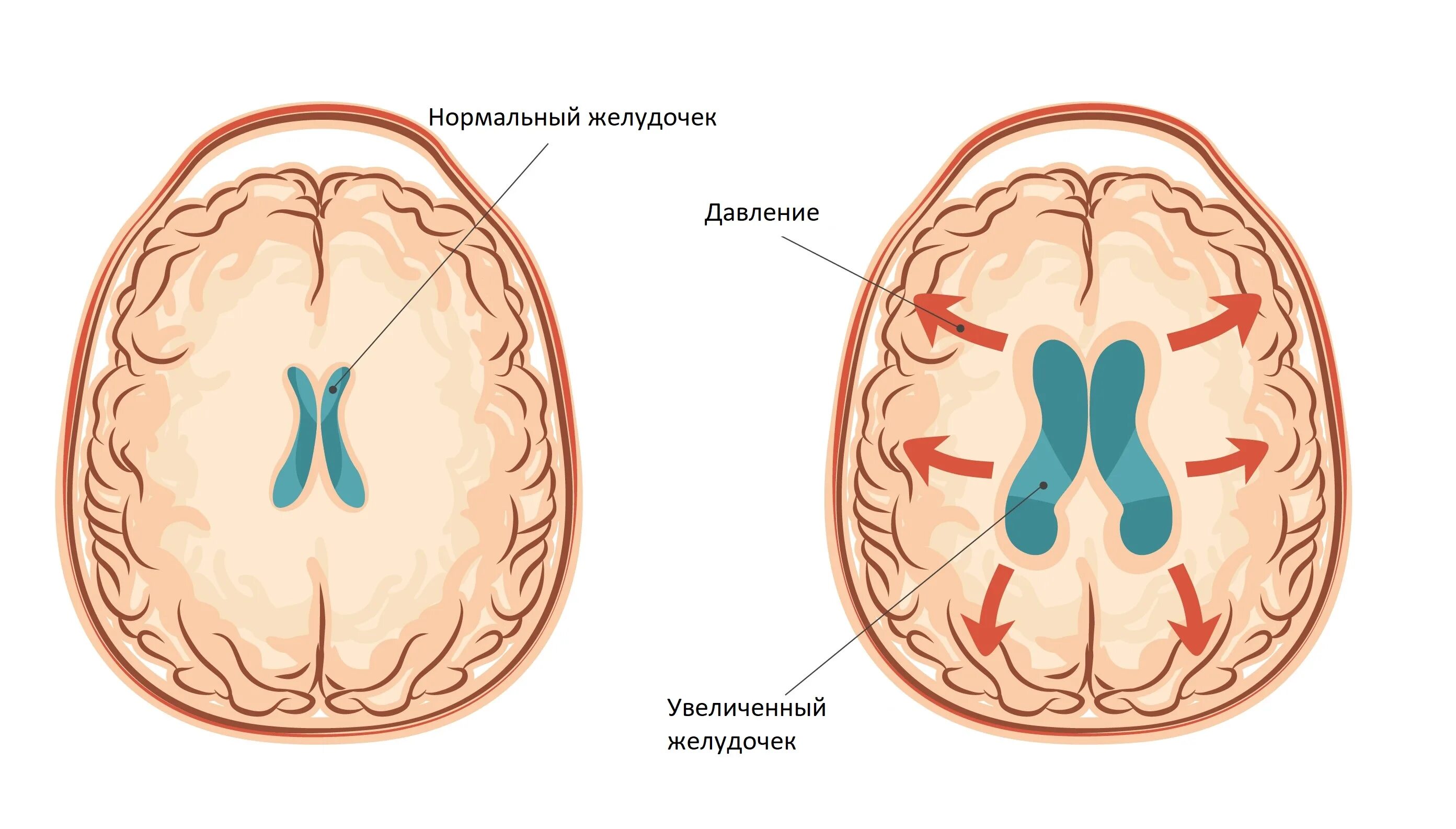 Внутричерепное давление головного мозга. Внутричерепное давление гидроцефалия. Водянка желудочков головного мозга. Гидроцефалия норма желудочков. Гидроцефалия боковых желудочков.