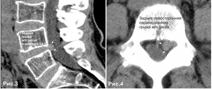 Медианно парамедианная билатеральная. Грыжа межпозвонкового диска на кт. Кт протрузии межпозвонковых дисков. Парамедианная грыжа диска на кт. Парамедианная протрузия межпозвонкового диска.