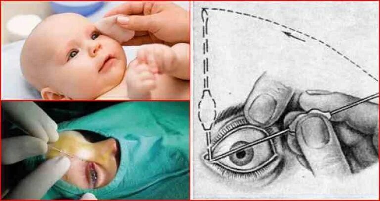 Массаж глаз слезного канала. Дакриоцистит у новорожденных зондирование. Дакриоцистит массаж слезного канала. Дакриоцистит массаж слезного канала у новорожденных. Массаж слёзного канала при дакриоцистите у детей.