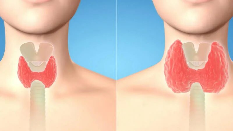 Здоровая щитовидная железа. Здоровая и больная щитовидка. Здоровая и нездоровая щитовидная железа.