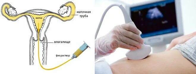 Процедура проходимости маточных труб. Ли узи маточные трубы. Гидроэхолокация маточных труб. Узи матки и маточных труб. Эхо гсг узи маточных труб.