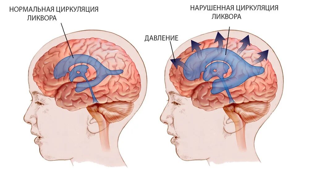 Ликвор прозрачный. Повышенное внутреннее черепное давление симптомы. Повышенный ликвор. Повышенный ликвор. Белок в ликворе.