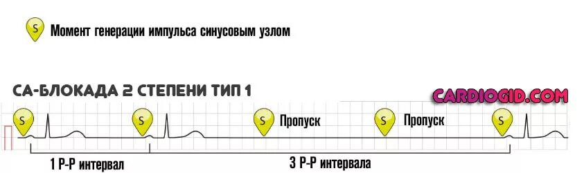 Синоатриальная блокада 2 степени типа Мобитц 1. Са блокада II степени 1 типа. Са блокада 2 степени 2 типа. Признаки синоатриальной блокады 2 степени. Са блокада степени