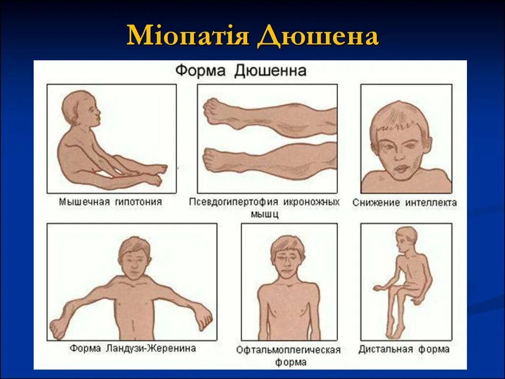 Клиническая миопатия. Мышечная дистрофия Дюшенна клинические проявления. Мышечная дистрофия миопатия Дюшенна. Псевдогипертрофическая миопатия. Миопатический синдром, миопатия.