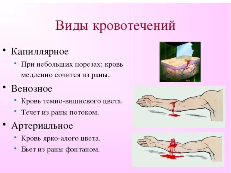 Первая помощь при наружных кровотечениях тест. Виды кравотичекравотичений. Кровотечение виды кровотечений. Перечислите виды кровотечений.