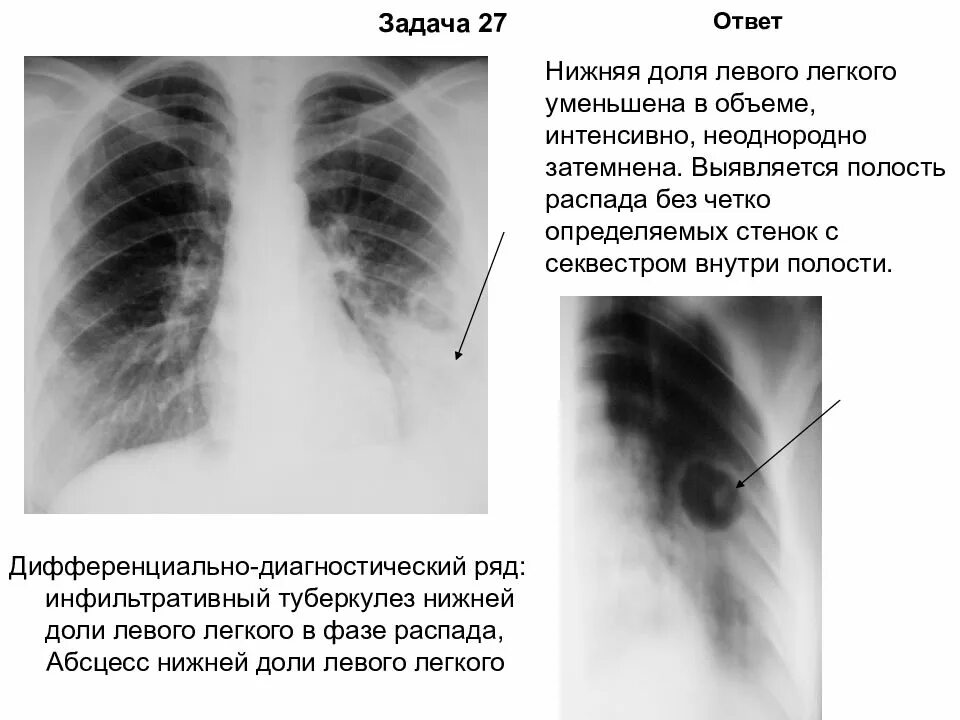 Инфильтративный туберкулез нижней доли правого легкого. Инфильтративный туберкулез нижней доли левого легкого. Туберкулез верхней доли правого легкого на рентгенограмме. Туберкулез нижней доли правого легкого. Затемнение в левом легком